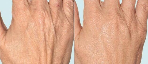 Piel de la mano antes y después de la terapia fraccionada.
