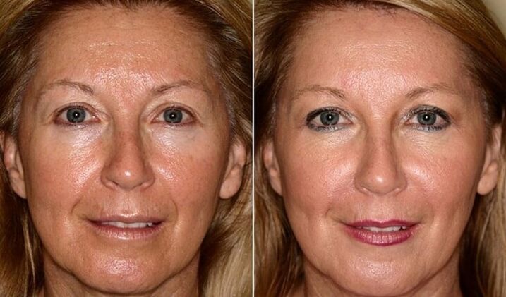 antes y después del rejuvenecimiento de la piel facial en casa