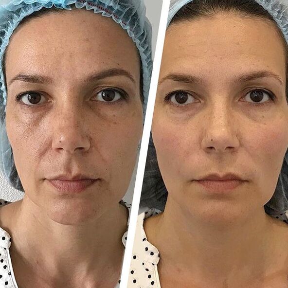 foto de la cara antes y después del rejuvenecimiento con láser